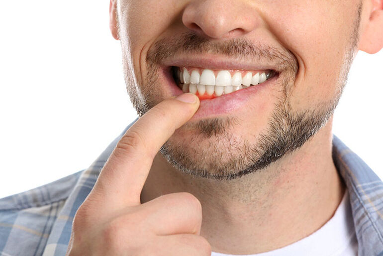 Gingivitis: qué es, síntomas, causas y tratamiento para prevenirla a tiempo